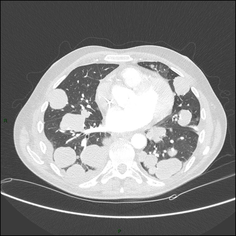 Cannonball metastases (Radiopaedia 82110-96150 Axial lung window 121).jpg