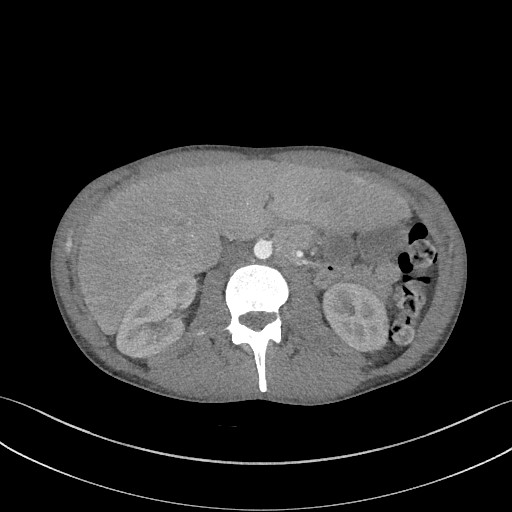 Cannonball metastases - testicular choriocarcinoma (Radiopaedia 84510-99891 B 125).jpg