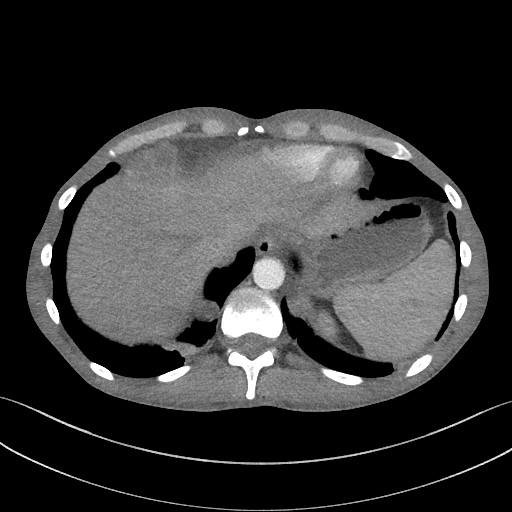 Cannonball metastases - testicular choriocarcinoma (Radiopaedia 84510-99891 B 93).jpg