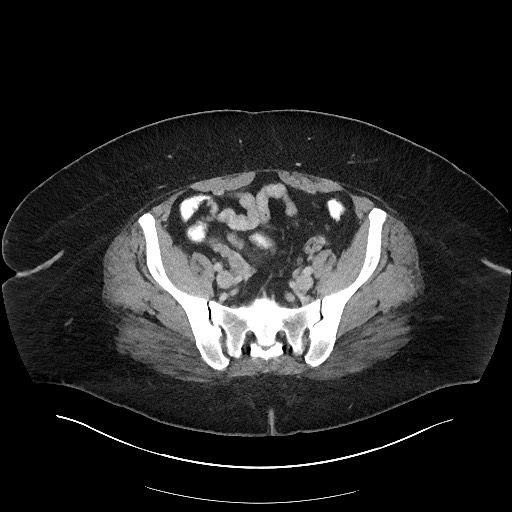File:Carcinoid tumor - terminal ileum (Radiopaedia 60931-68739 A 102).jpg