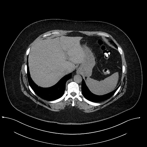 File:Carcinoid tumor - terminal ileum (Radiopaedia 60931-68740 Axial non-contrast 11).jpg