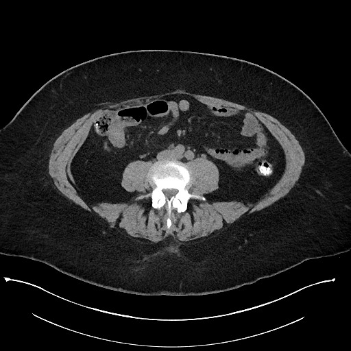 Carcinoid tumor - terminal ileum (Radiopaedia 60931-68740 Axial non-contrast 69).jpg