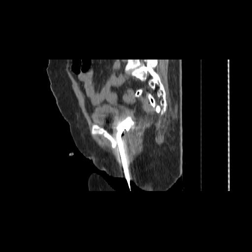 File:Carcinoma cervix- brachytherapy applicator (Radiopaedia 33135-34173 D 110).jpg