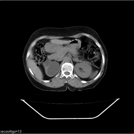File:Carcinoma cervix- recurrence (Radiopaedia 34702-36137 Axial non-contrast 16).jpg