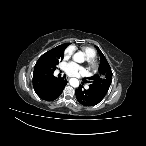 File:Cardiac hydatid disease (Radiopaedia 64684-73611 Axial with contrast 24).jpg