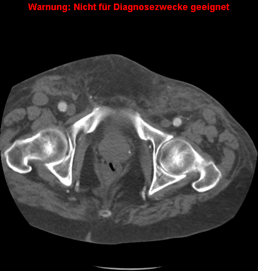 File:Cardiac perforation following transcatheter aortic valve implantation (Radiopaedia 23714-23863 B 9).png