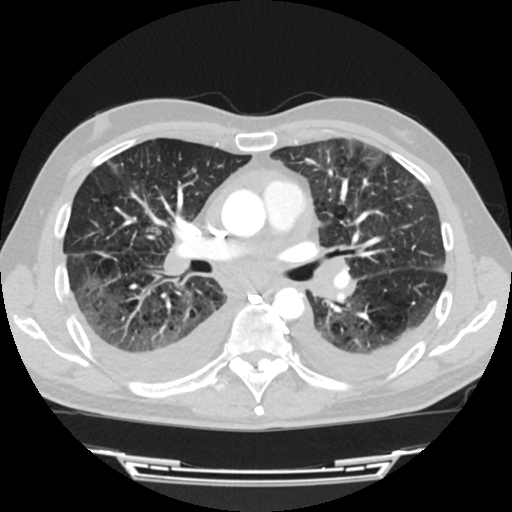 File:Cardiac tamponade (Radiopaedia 78607-91368 Axial lung window 39).jpg