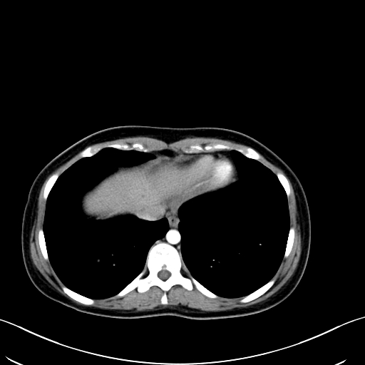 Caroli disease with medullary sponge kidney (Radiopaedia 82622-96804 C 11).jpg