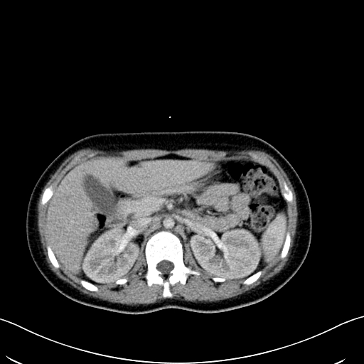 Caroli disease with medullary sponge kidney (Radiopaedia 82622-96804 C 26).jpg