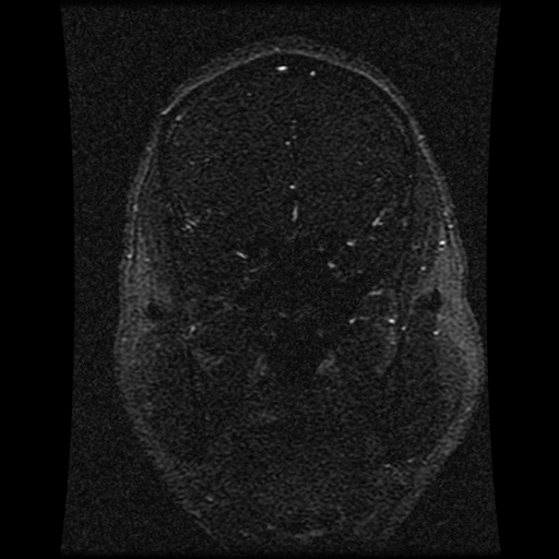 Carotid arterial dissection with acute cerebral infarction (Radiopaedia 26636-26784 MRV 116).jpg
