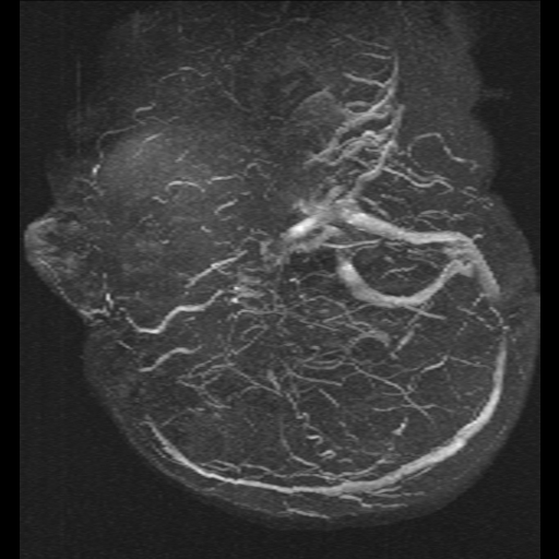 Carotid arterial dissection with acute cerebral infarction (Radiopaedia 26636-26784 MRV 18).jpg