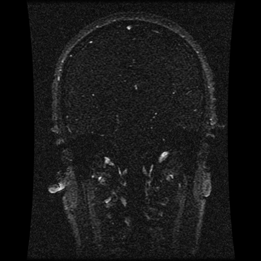 File:Carotid arterial dissection with acute cerebral infarction (Radiopaedia 26636-26784 MRV 88).jpg