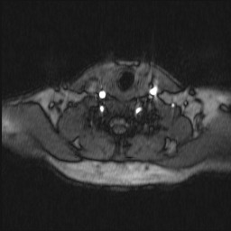 Carotid artery dissection (Radiopaedia 28441-28689 Axial MRA 20).jpg