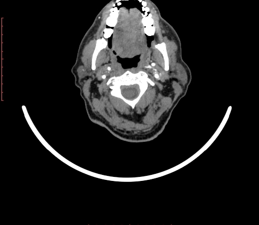 Carotid body tumor (Radiopaedia 66785-76116 B 2).jpg