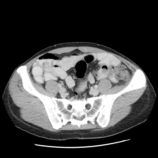 Castleman disease with fibrous pseudotumor in the abdomen (Radiopaedia 77296-89373 A 93).jpg