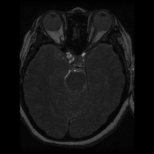 Cavernoma, DVA and right ICA aneurysm (Radiopaedia 33890-35072 E 54).png