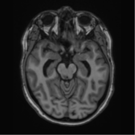 File:Cavernoma with bleed - midbrain (Radiopaedia 54546-60774 Axial T1 13).png