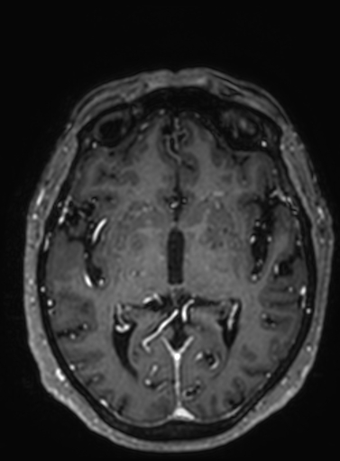Cavernous hemangioma of the cerebellar falx (Radiopaedia 73025-83724 Axial T1 C+ 177).jpg