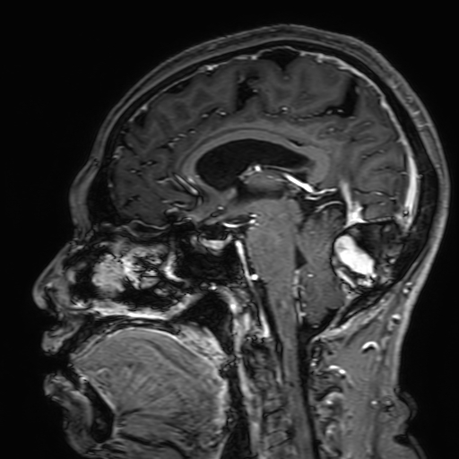 Cavernous hemangioma of the cerebellar falx (Radiopaedia 73025-83724 Sagittal T1 C+ 101).jpg
