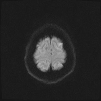 File:Cavernous sinus meningioma (Radiopaedia 63682-72367 DWI 60).jpg
