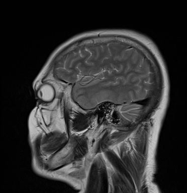 File:Cavernous sinus meningioma (Radiopaedia 63682-72367 Sagittal T2 4).jpg