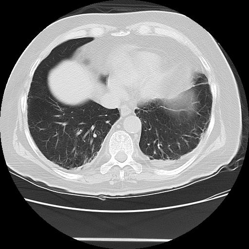 Cavitating pulmonary metastases (Radiopaedia 89545-106544 Axial lung window 42).jpg