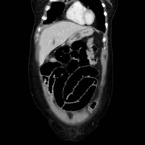 Cecal adenocarcinoma (Radiopaedia 75909-87331 B 14).jpg
