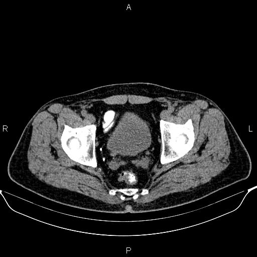Cecal adenocarcinoma (Radiopaedia 85324-100916 Axial non-contrast 91).jpg