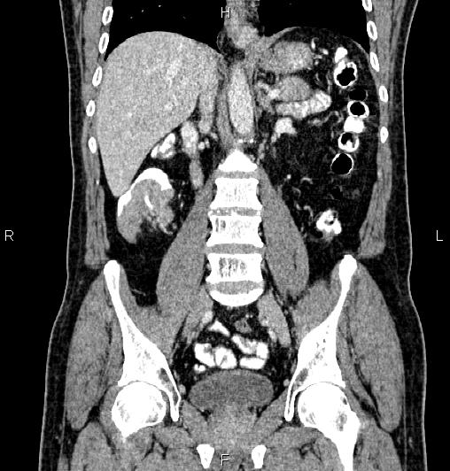 Cecal adenocarcinoma (Radiopaedia 85324-100916 D 37).jpg