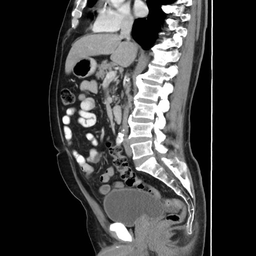Cecal mass causing appendicitis (Radiopaedia 59207-66531 C 31).jpg