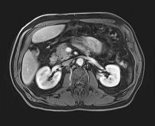 Cecal mass causing appendicitis (Radiopaedia 59207-66532 T1 C+ PV phase 56).jpg
