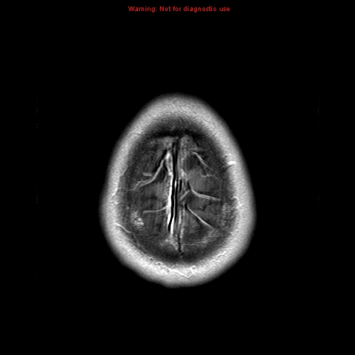 File:Central nervous system vasculitis (Radiopaedia 8410-9235 Axial T1 C+ 23).jpg