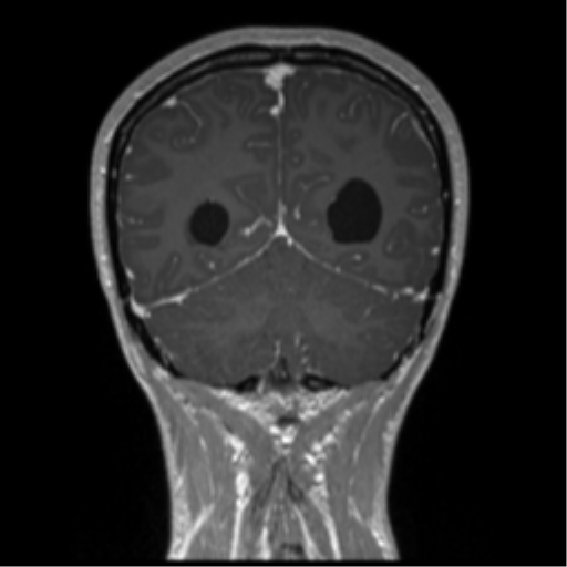 Central neurocytoma (Radiopaedia 37664-39557 Coronal T1 C+ 22).png