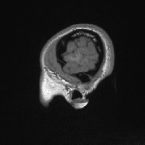 Central neurocytoma (Radiopaedia 37664-39557 Sagittal T1 11).png