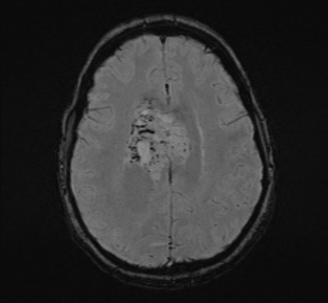 Central neurocytoma (Radiopaedia 70263-80336 Axial SWI 41).jpg