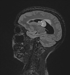 Central neurocytoma (Radiopaedia 84497-99872 Sagittal Flair + Gd 55).jpg