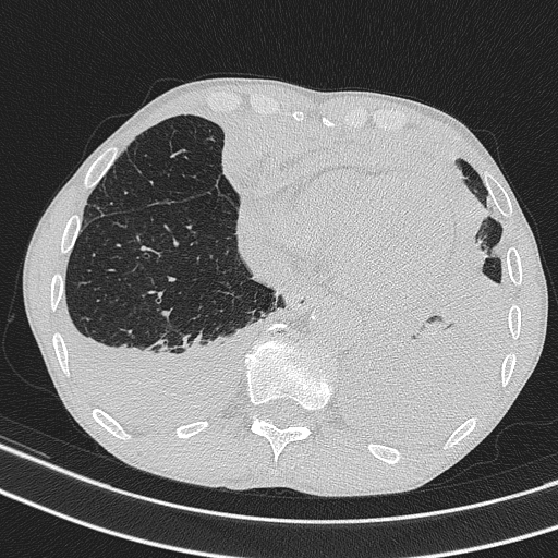 Central venous catheter tip extravasation (Radiopaedia 82828-97113 Axial lung window 66).jpg