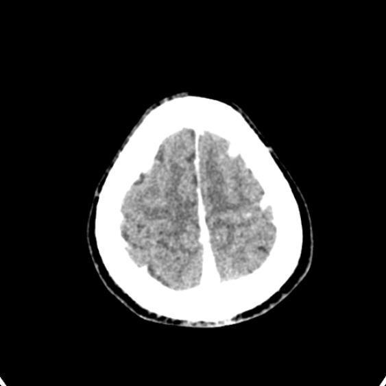 Cerebellar abscess secondary to mastoiditis (Radiopaedia 26284-26412 Axial C+ delayed 139).jpg