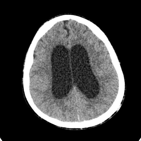 Cerebellar abscess secondary to mastoiditis (Radiopaedia 26284-26412 Axial non-contrast 106).jpg