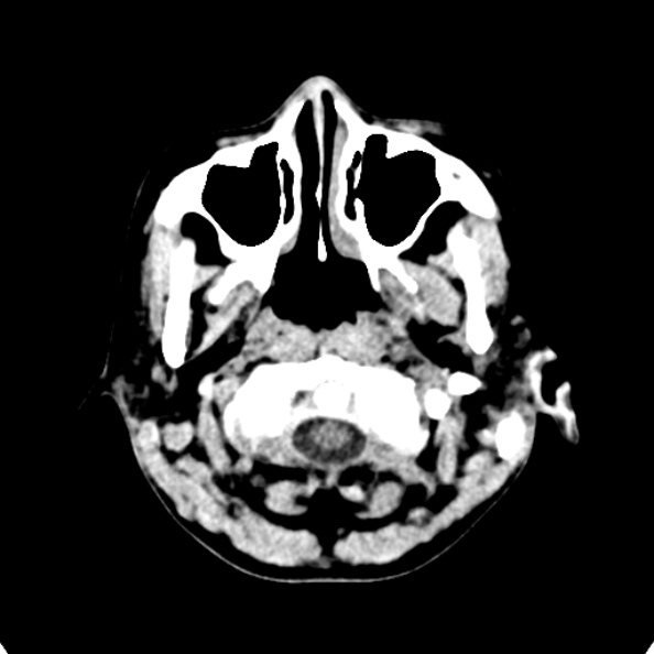 Cerebellar abscess secondary to mastoiditis (Radiopaedia 26284-26412 Axial non-contrast 6).jpg