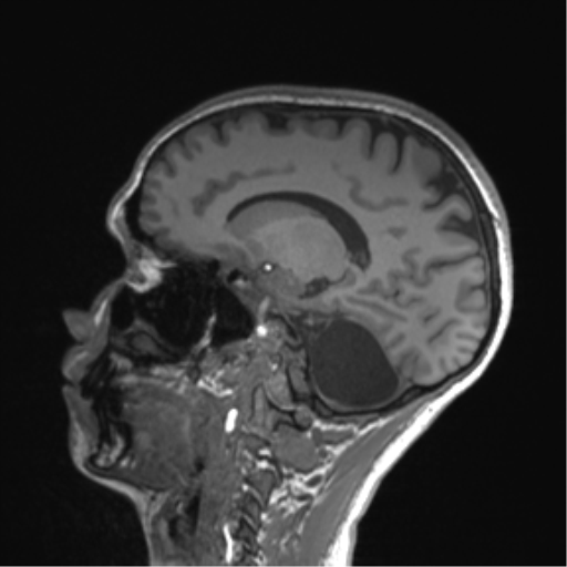 Cerebellar agenesis with hypoplastic pons (pontocerebellar hypoplasia) (Radiopaedia 57224-64138 Sagittal T1 41).png