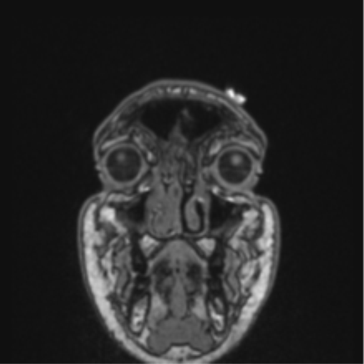 File:Cerebellar hemangioblastomas and pituitary adenoma (Radiopaedia 85490-101176 Coronal T1 85).png