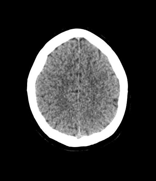 Cerebellar metastases - colorectal adenocarcinoma (Radiopaedia 40947-43652 Axial non-contrast 53).png