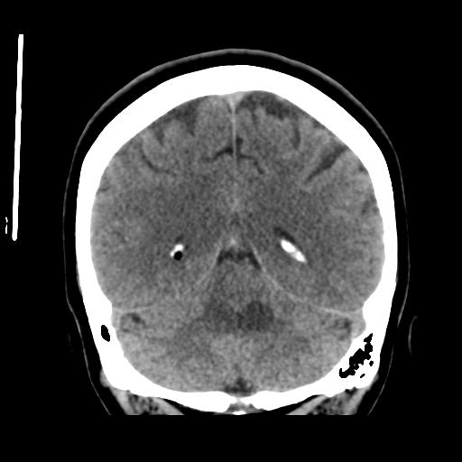 Cerebellar metastasis (cystic appearance) (Radiopaedia 41395-44258 Coronal non-contrast 44).png