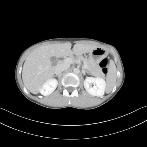 Cerebellar metastasis - adenocarcinoma lung (Radiopaedia 63184-71717 Axial C+ delayed 72).png