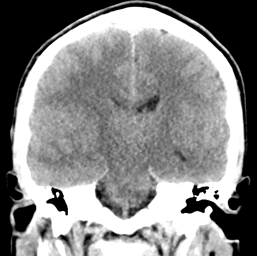 File:Cerebral abscess (Radiopaedia 60342-68008 Coronal non-contrast 35).png