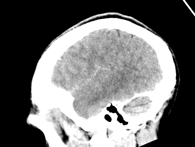 File:Cerebral abscess (Radiopaedia 60342-68008 Sagittal C+ delayed 10).png