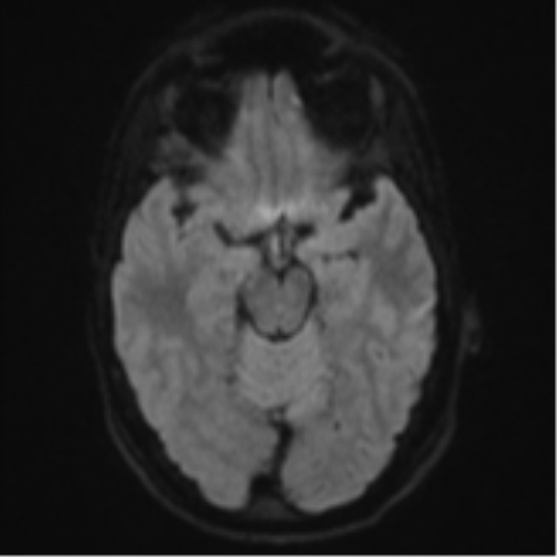 File:Cerebral abscess (Radiopaedia 60342-68009 Axial DWI 49).png