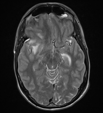 File:Cerebral abscess (Radiopaedia 60342-68009 Axial T2 14).png