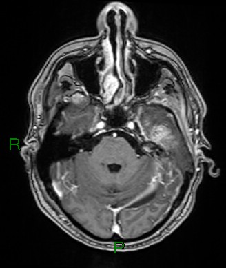 Cerebral abscess and subdural empyema (Radiopaedia 84436-99779 Axial T1 C+ 62).jpg